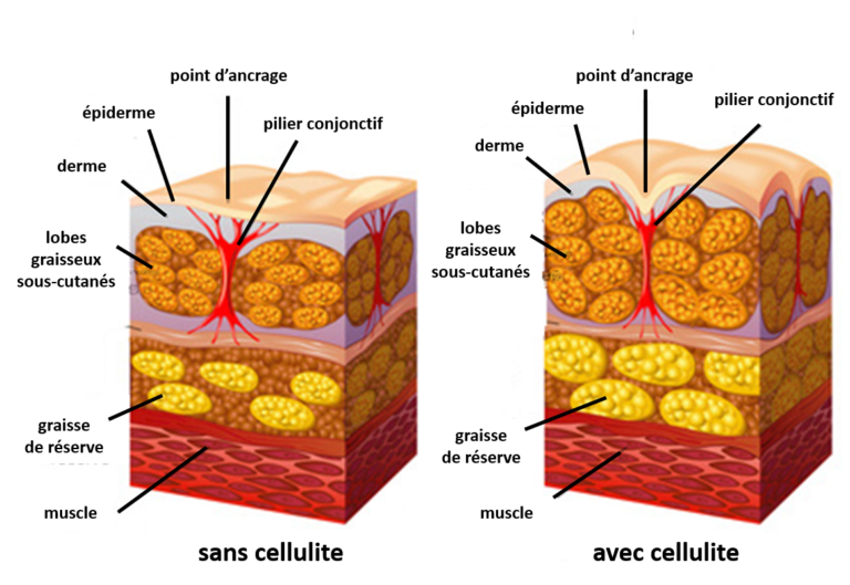 explication cellulite