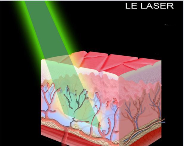 laser vasculaires paris